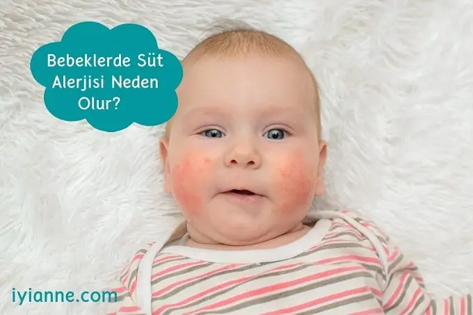 Bebeklerde Süt Alerjisi Neden Olur?